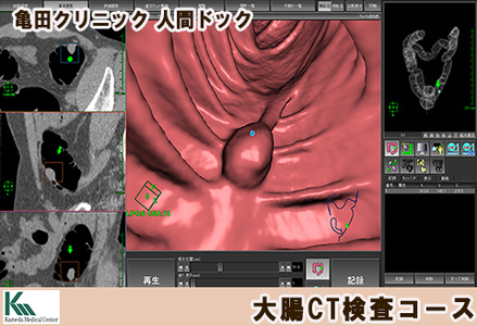 【亀田クリニック人間ドック】大腸CT検査コース　１名様（単独）　[0130-0001]